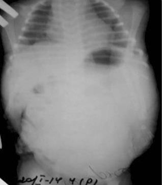 Оглядова рентгенограма ОГК і черевної порожнини новонародженого (2іга доба життя).