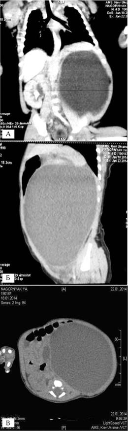 Постнатальна комп`ютерна томографія ОЧП з внутріші ньовенним контрастуванням новонародженого О. на 6іту добу життя (а, б, в).