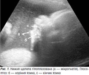 Унікальний випадок пренатальної діагностики синдрому П'єра Робена з клонічними судомами в плода.