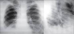 Рисунок 1. Рентгенограма органів грудної порожнини та томограма правої легені при первинному зверненні проліферація мезотелію з прикметами дистрофії в цитоплазмі, зустрічаються групи клітин зі збільшеними ядерцями у ядрах клітин, МБТ не виявлені.