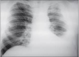 Рентгенограма органів грудної порож-нини на консультативному прийомі у ЗОПТКД.