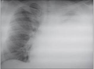Рентгенограма органів грудної порожнини на консультативному прийомі у ЗОПТКД.