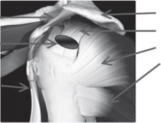 Анатомічна модель плечового суглоба (лівого) із зображенням локалізації критичної зони Кодмана.